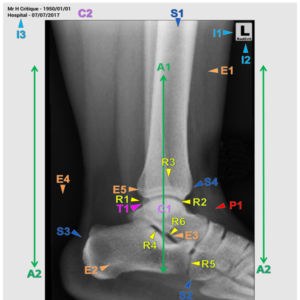 ANKLE - LAT/EXT OBL (3 CEUs)