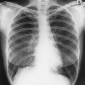 Chest