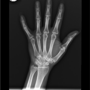 Upper Extremities