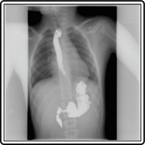 UPPER GI