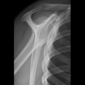 Shoulder