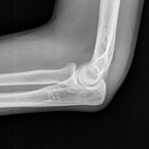 Elbow