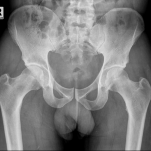 Hip and Pelvis