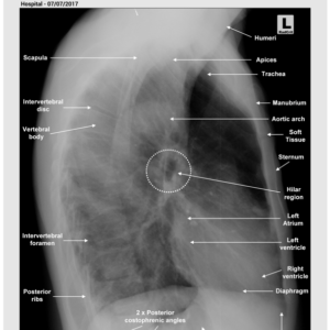 CHEST- LATERAL - ANATOMY