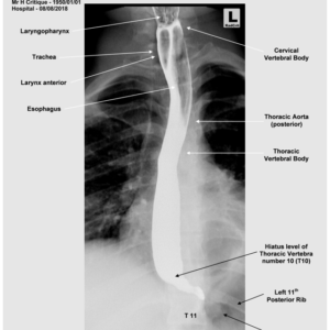 ESOPHAGRAM - AP/OBLIQUE/LATERAL - ANATOMY