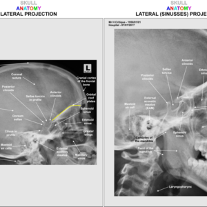 SKULL - LAT/SINUSES - ANATOMY - Image 1