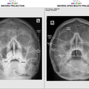 SKULL- WATERS/OPEN MOUTH - ANATOMY